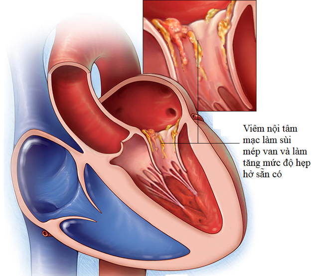 2. Triệu Chứng và Dấu Hiệu Nhận Biết